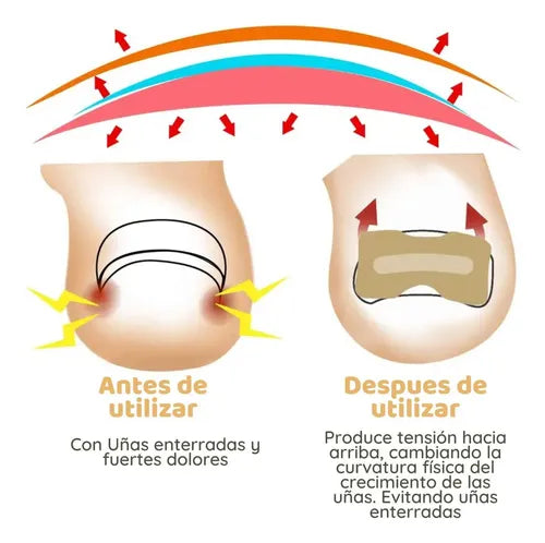 Parches Para Uñas Encarnadas (50 Unidades)